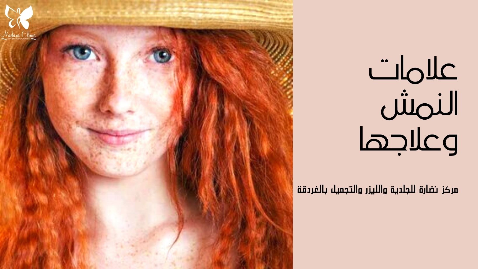 علامات النمش